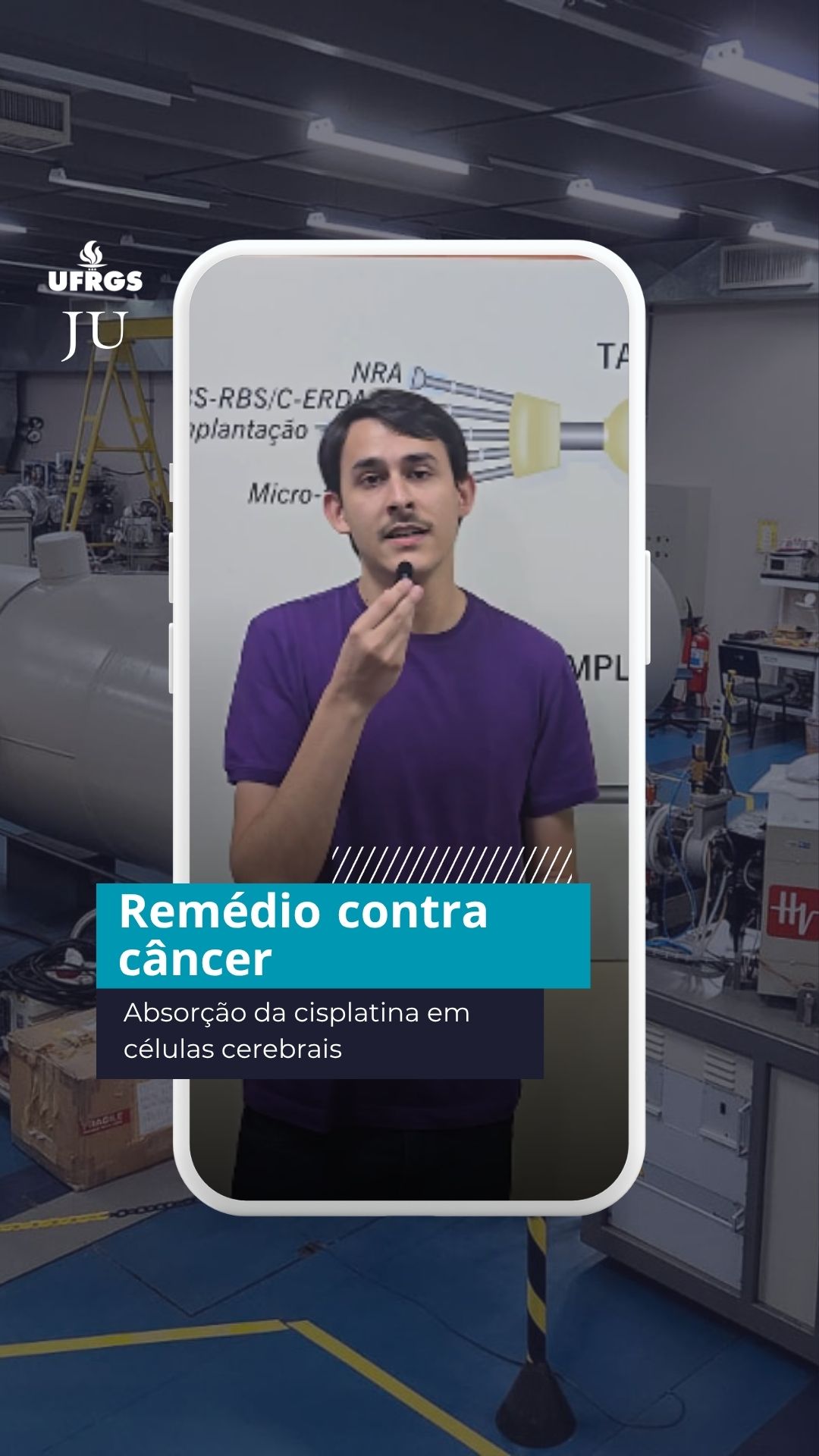 Física | Estudo mostra que remédio contra câncer é absorvido de forma diferente em célula cerebral

Utilizada há décadas na quimioterapia, a cisplatina é um medicamento à base de platina empregado no tratamento de diferentes tipos de câncer. Uma pesquisa desenvolvida na UFRGS investigou como células de glioblastoma, um dos tumores cerebrais mais agressivos, absorvem o fármaco e como essa diferença se relaciona com a morte celular.

O estudo, conduzido pelo doutorando em física Henrique Fonteles, identificou que células de uma mesma linhagem tumoral absorvem quantidades diferentes do remédio. A pesquisa também mostrou que aquelas com maior absorção apresentam maior acúmulo de ferro, associado à ferroptose, um tipo de morte celular.

Os resultados da pesquisa básica abrem espaço para novos estudos, que poderão avaliar se os mecanismos identificados podem contribuir para o desenvolvimento de estratégias terapêuticas mais eficazes contra esse tipo de câncer.

📝Isabela Daudt